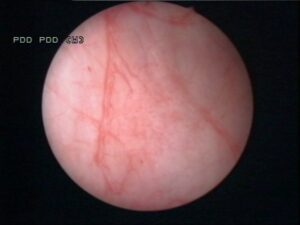 3_B8w_19-25-08_Courtesy_of_Dirk_Zaak_Associate_Proffessor__Dep._of_Urology_University_of_Munich